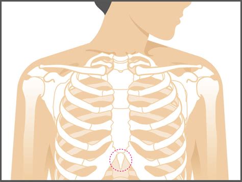 Costochondritis occurs most often in women older than 40. . Sternum sticks out female